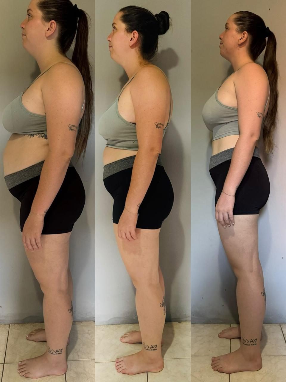Antes e depois caso 05